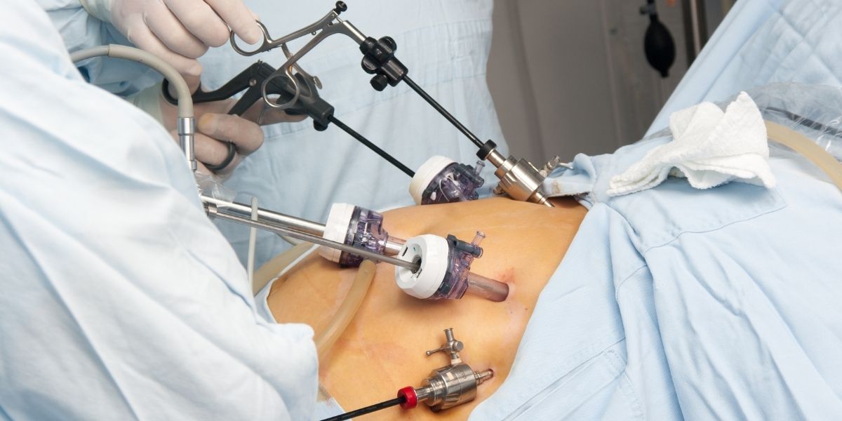 Laparoscopia