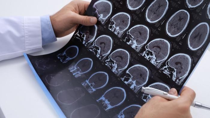 Imatge radiodiàgnostica d'un cervell