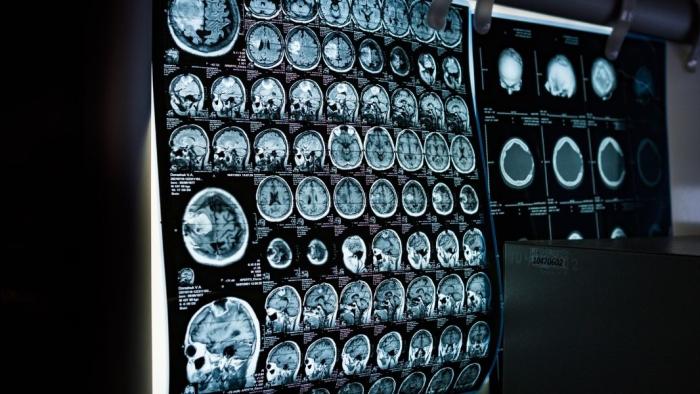 Imatge radiodiàgnostica d'un cervell