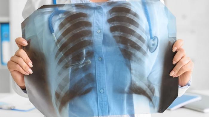 Metgessa amb una radiografia pulmonar