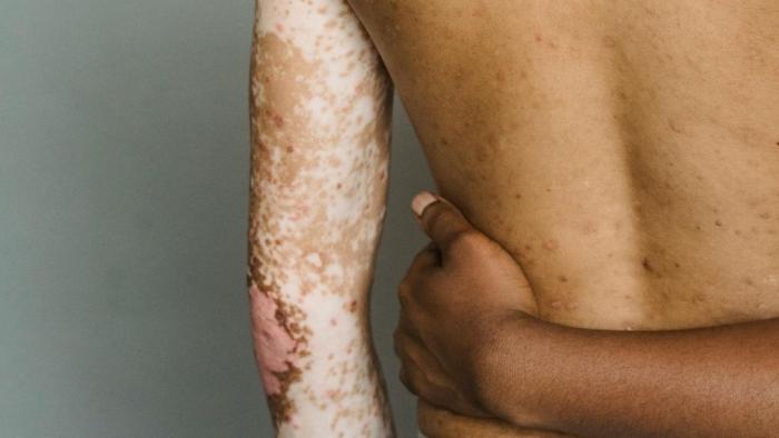 Persona amb psoriasi