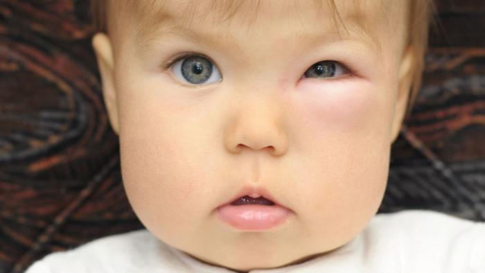 Nadó amb inflamació ocular