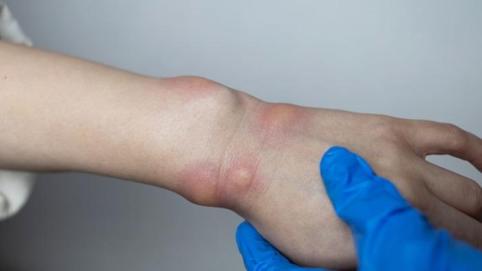 Angioedema hereditari a les mans