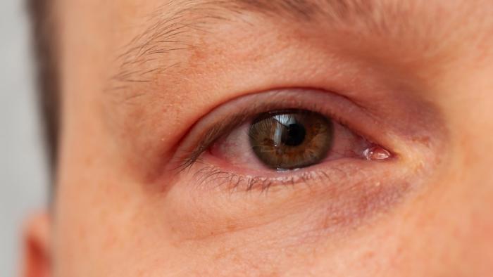 Deficiència macular associada a l'edat