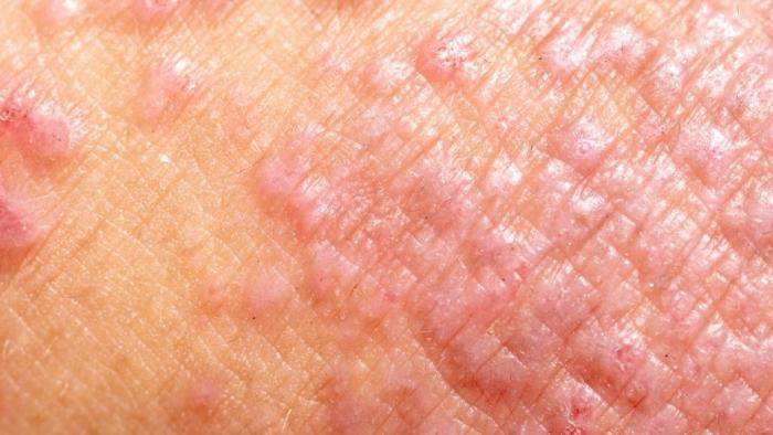 Pell amb dermatitis atòpica