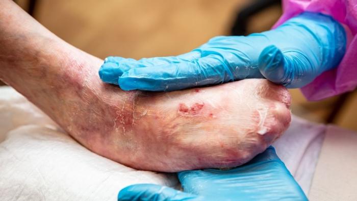 Infermera fent una cura a un pacient amb pell de papallona