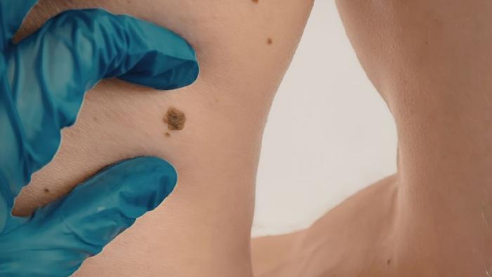 Melanoma cutani