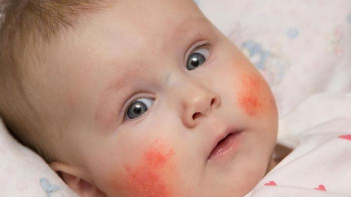 Nadó amb sindrome de kawasaki