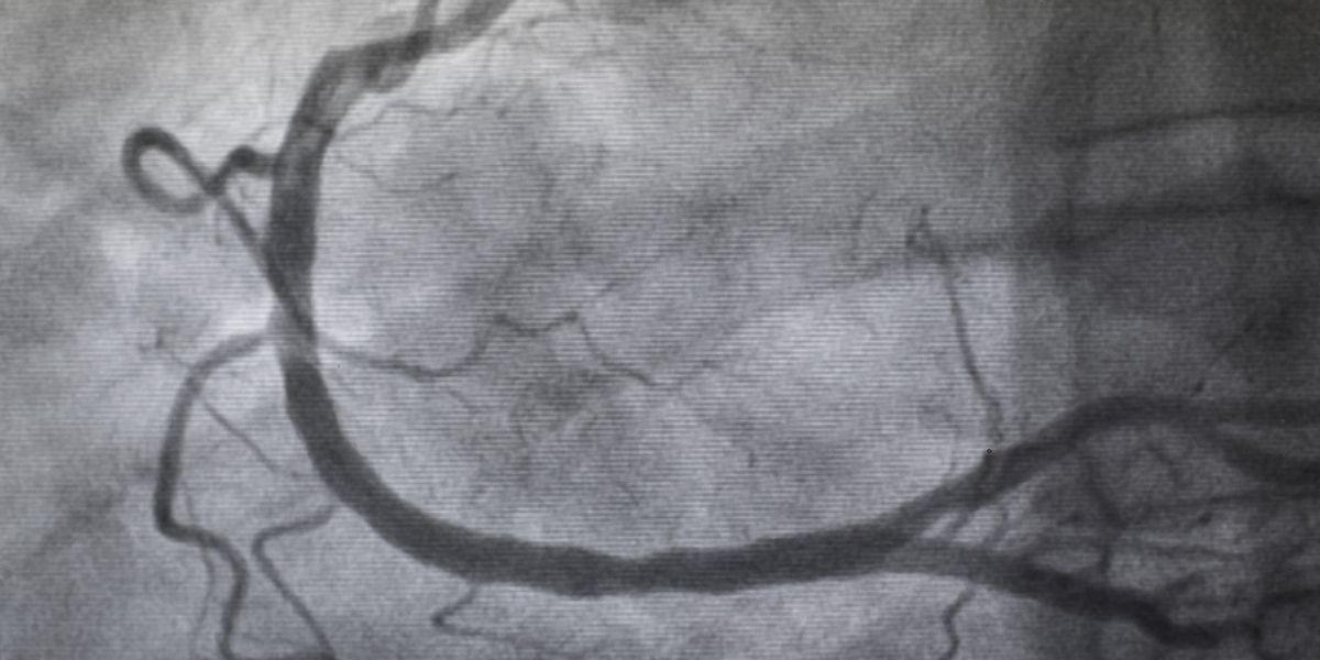 Imatge d'una arteriografia