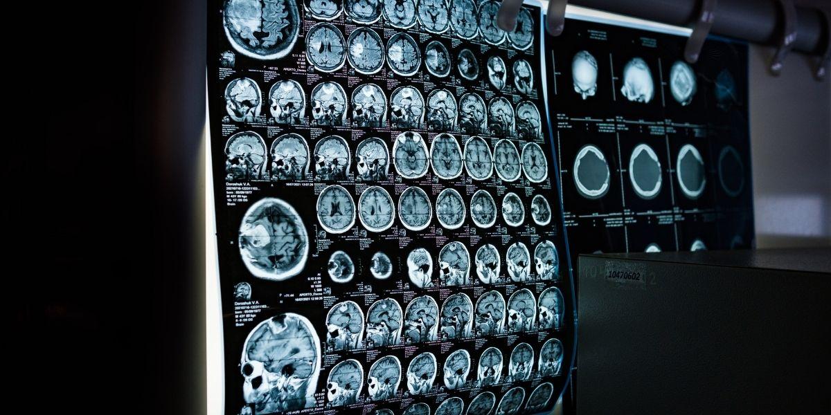 Imatge radiodiàgnostica d'un cervell