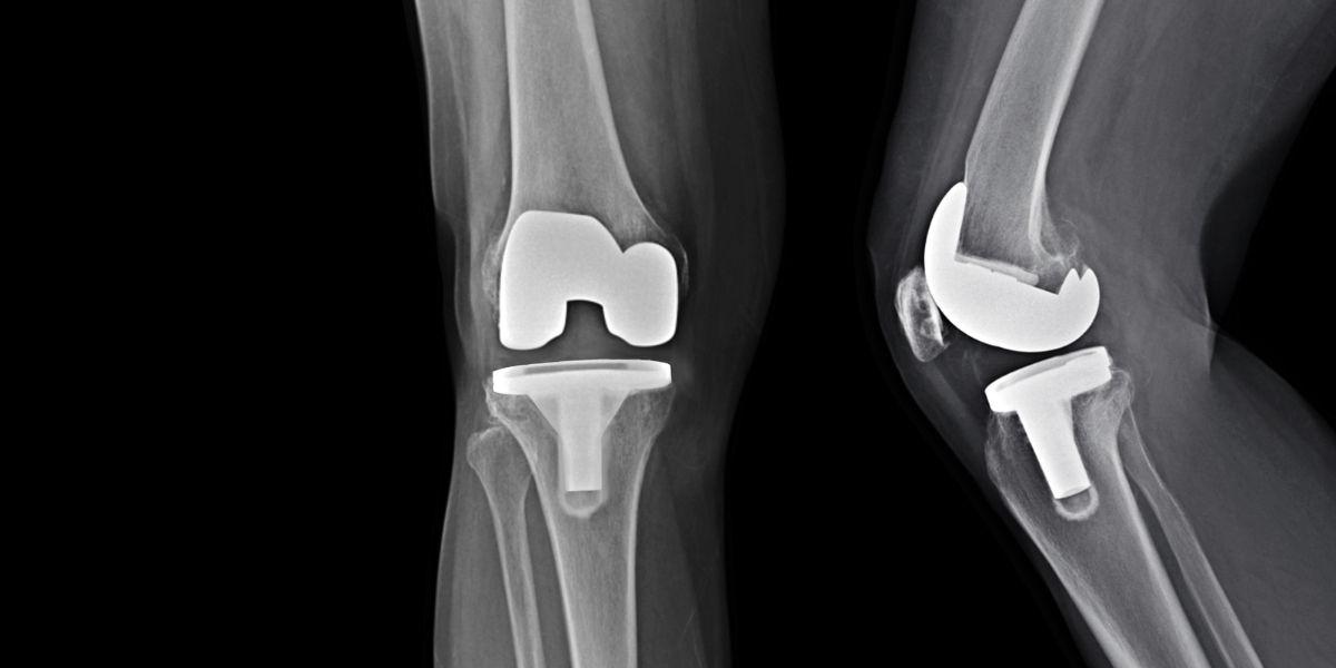 Pròtesi total de genoll
