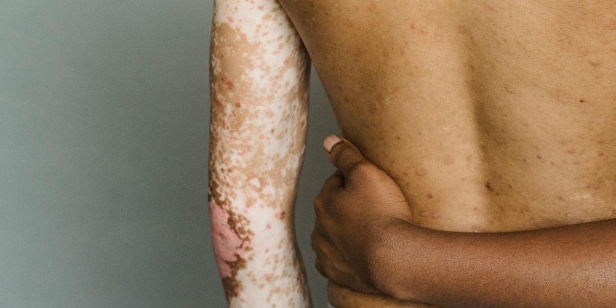 Persona amb psoriasi