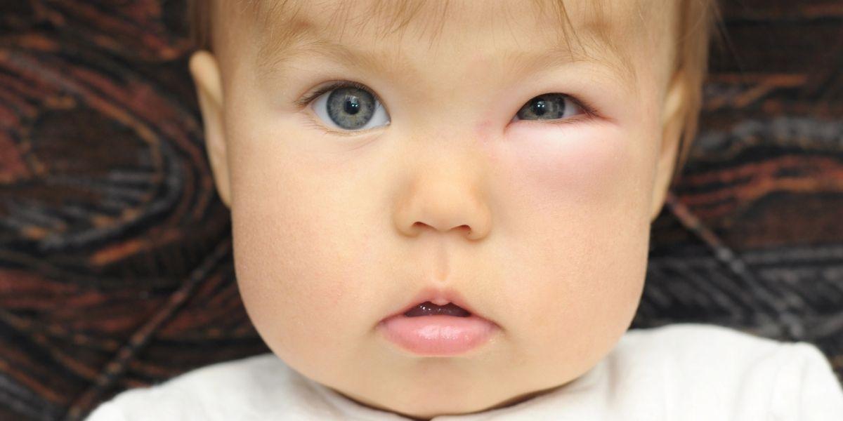 Nadó amb inflamació ocular