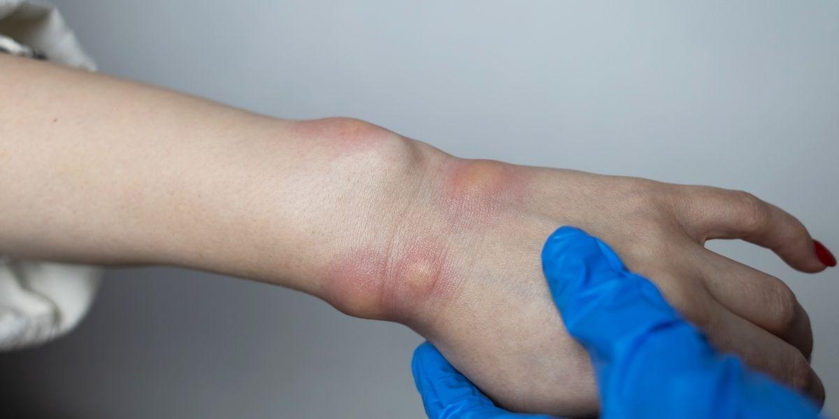 Angioedema hereditari a les mans