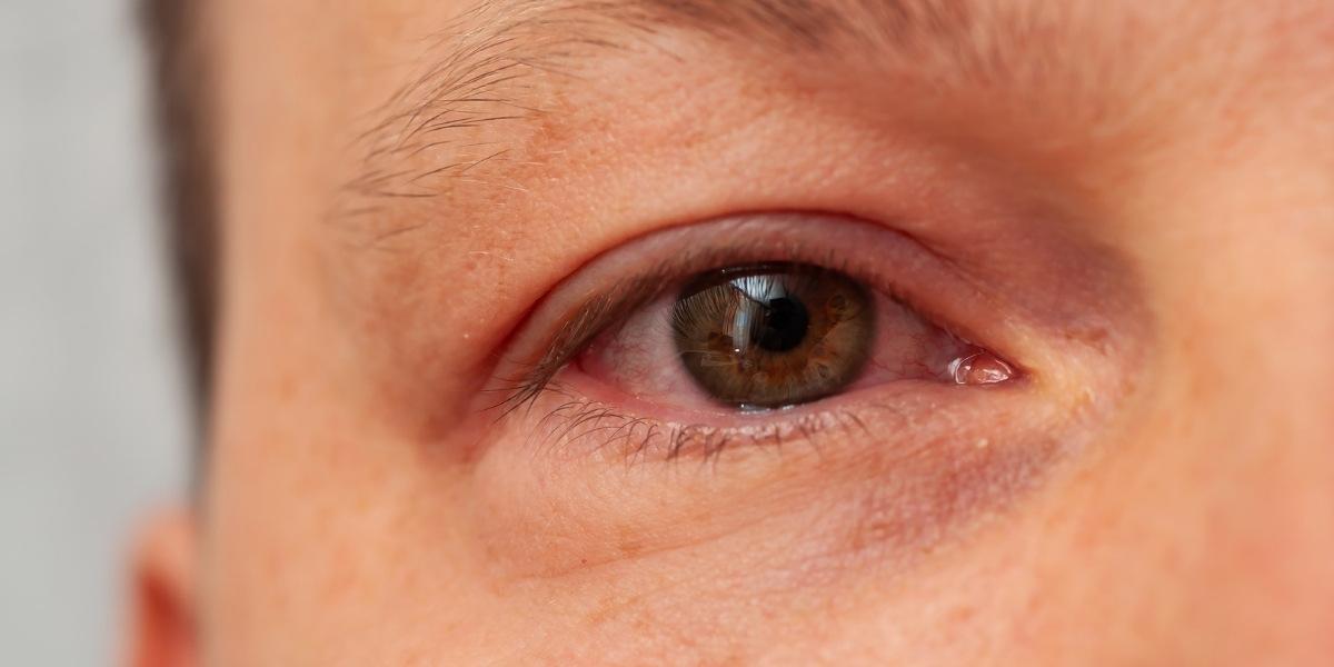 Deficiència macular associada a l'edat
