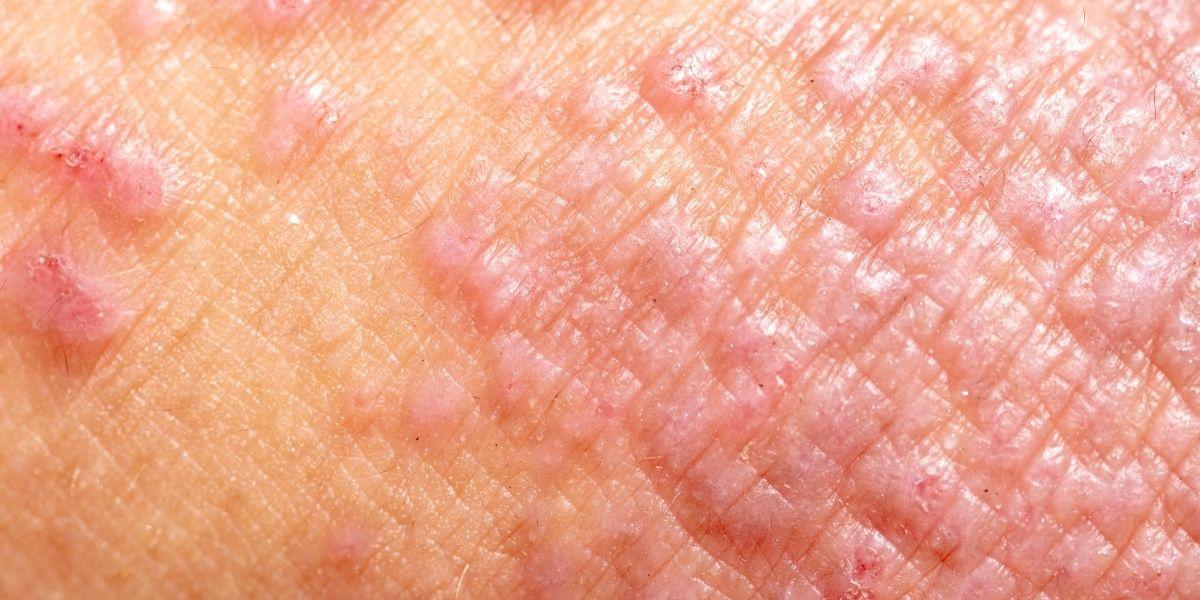 Pell amb dermatitis atòpica