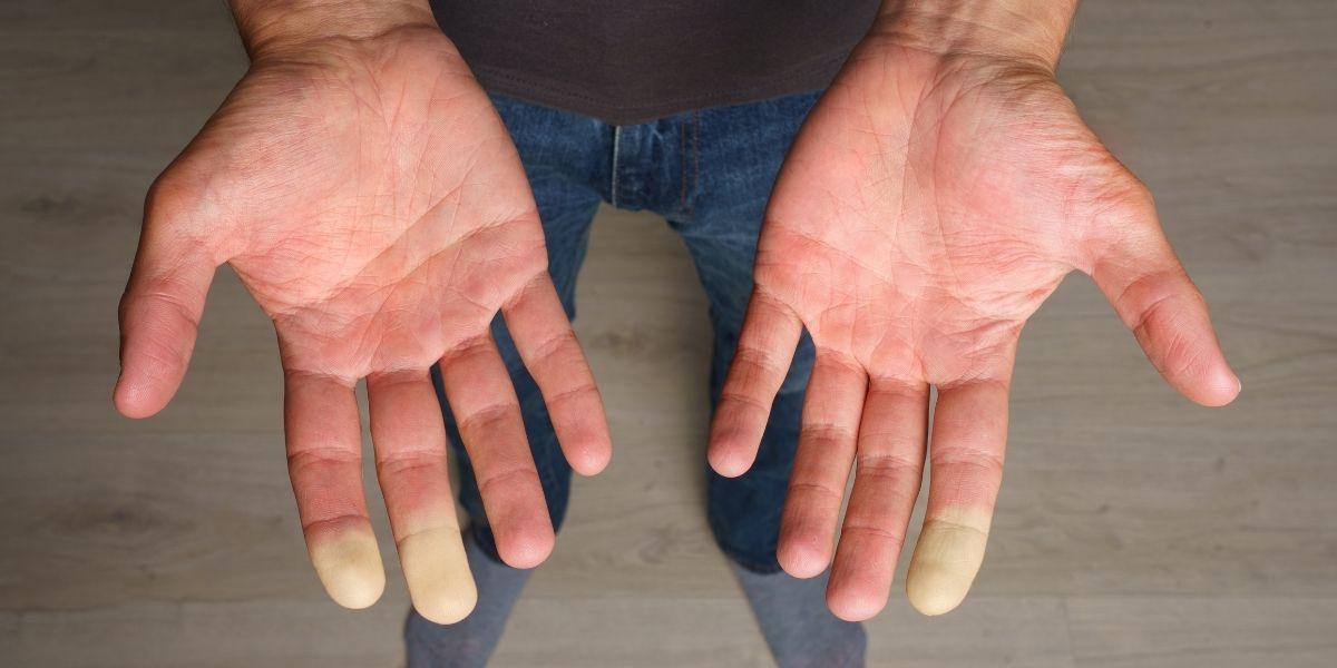 Fenomen de Raynaud