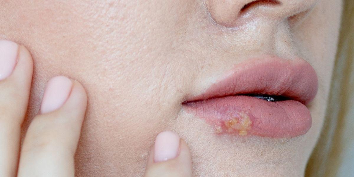 Noia amb un herpes al llavis