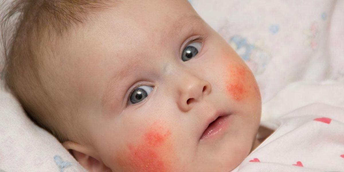 Nadó amb sindrome de kawasaki