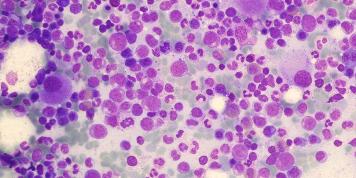 Síndrome mielodisplàsic