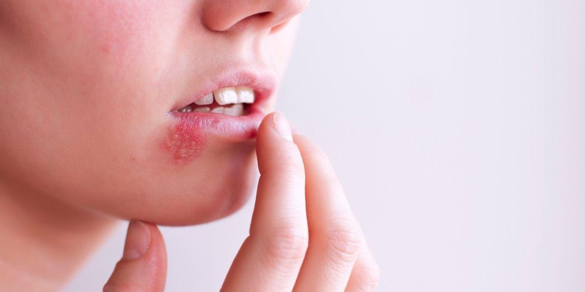 Herpes simple