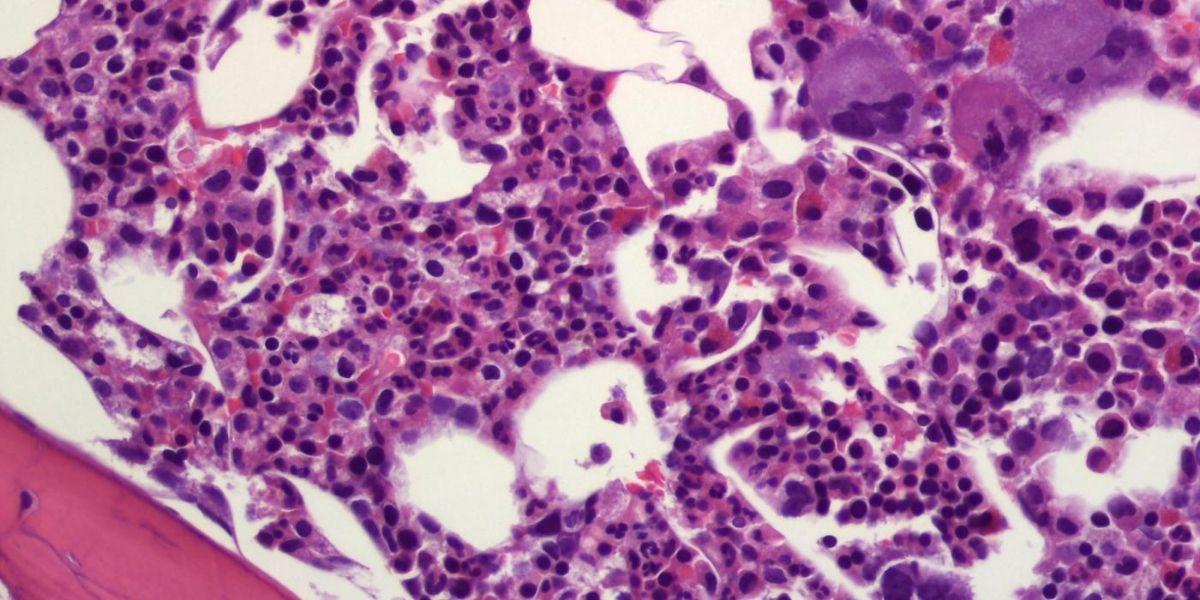 Trombocitèmia essencial