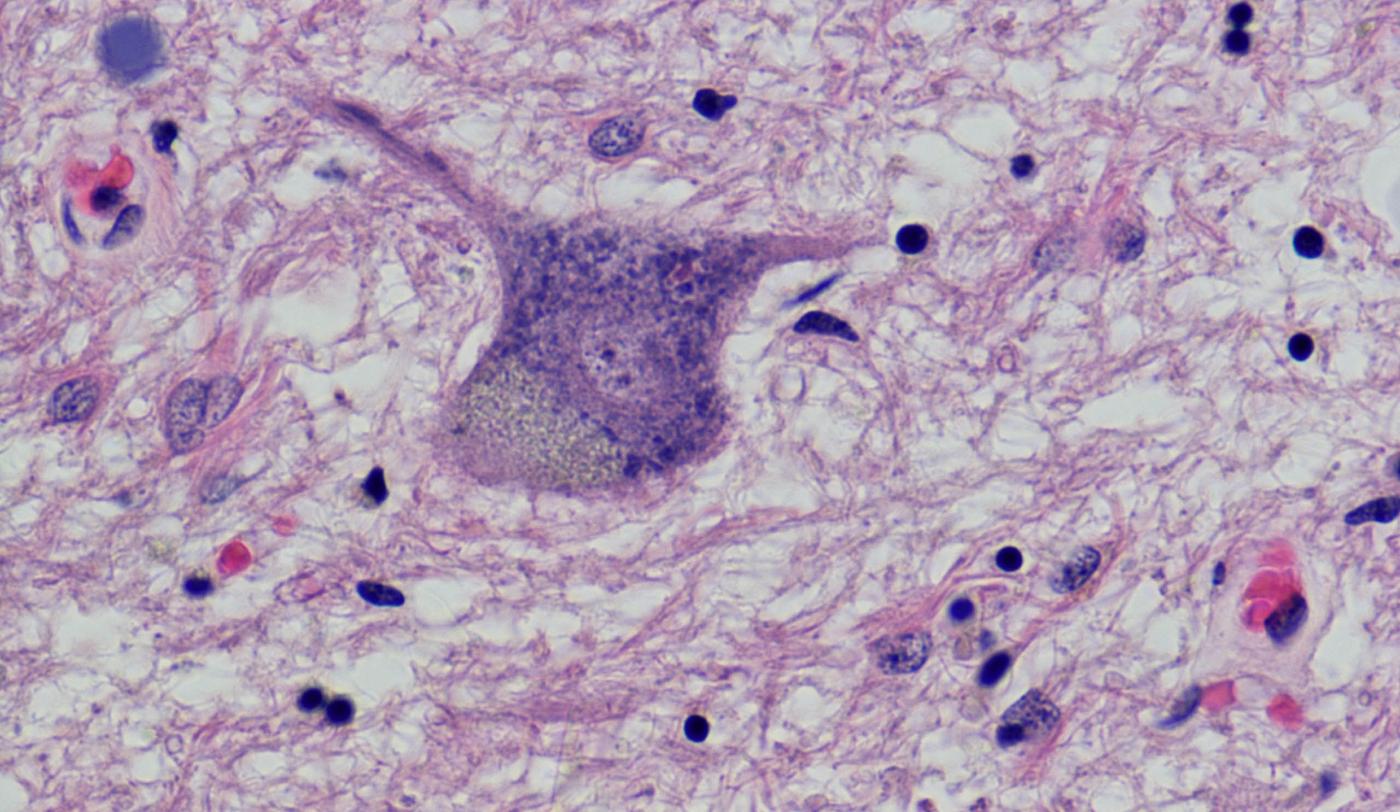 Esclerosis Lateral Amiotrófica (ELA) a Vall d'Hebron