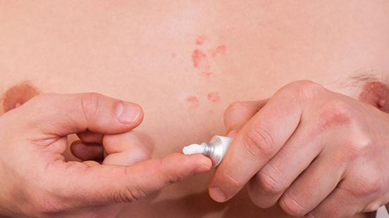 Herpes zòster a Vall d'Hebron