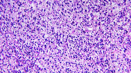 Tumor extraocular en la infància (Rabdomiosarcoma) a Vall d'Hebron